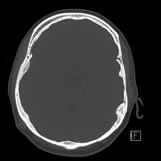 Calcified chronic subdural hematoma (Radiopaedia 77374-89492 Axial bone window 48).jpg