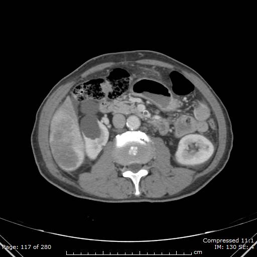 Calcified liver metastases (Radiopaedia 44699-48470 B 42).jpg