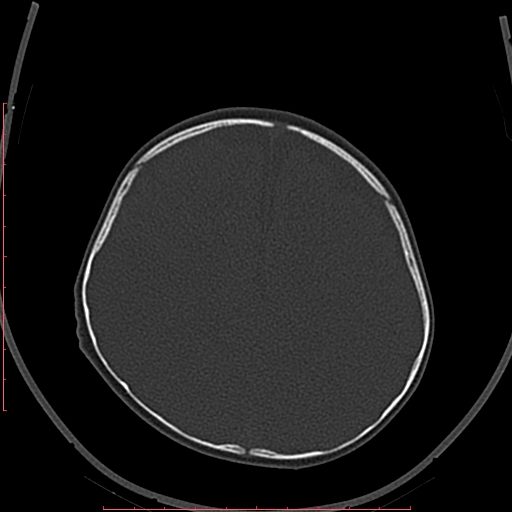 File:Calcified middle cerebral artery embolism (Radiopaedia 78949-91860 Axial bone window 53).jpg