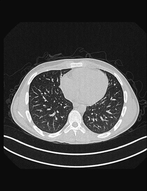 Calcifying pulmonary metastases (Radiopaedia 33359-34396 Axial lung window 43).jpg