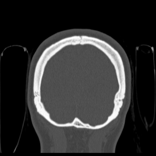 Calvarial osteoma (Radiopaedia 36520-38079 C 83).jpg