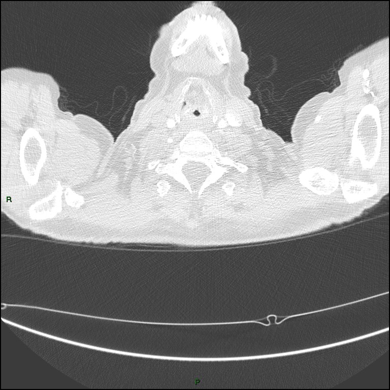 Cannonball metastases (Radiopaedia 82110-96150 Axial lung window 7).jpg