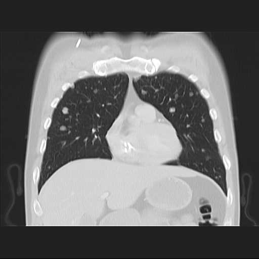 File:Cannonball pulmonary metastases (Radiopaedia 67684-77101 C 7).jpg