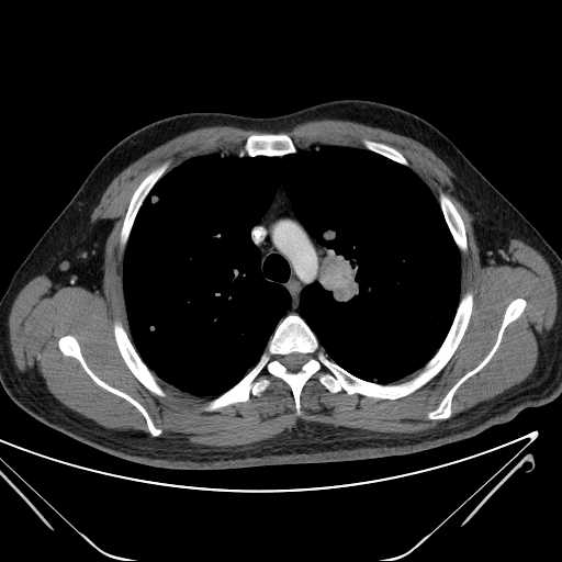 File:Cannonball pulmonary metastases (Radiopaedia 67684-77101 D 89).jpg
