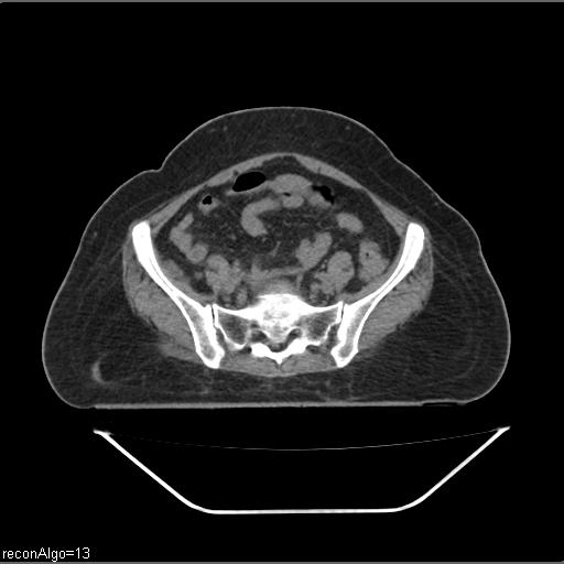 Carcinoma cervix- brachytherapy applicator (Radiopaedia 33135-34173 Axial non-contrast 9).jpg