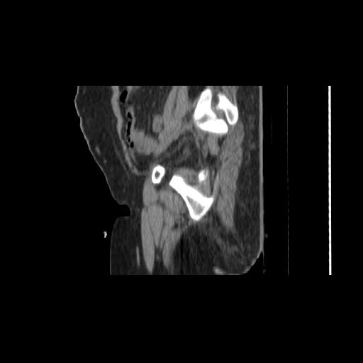 File:Carcinoma cervix- brachytherapy applicator (Radiopaedia 33135-34173 D 37).jpg