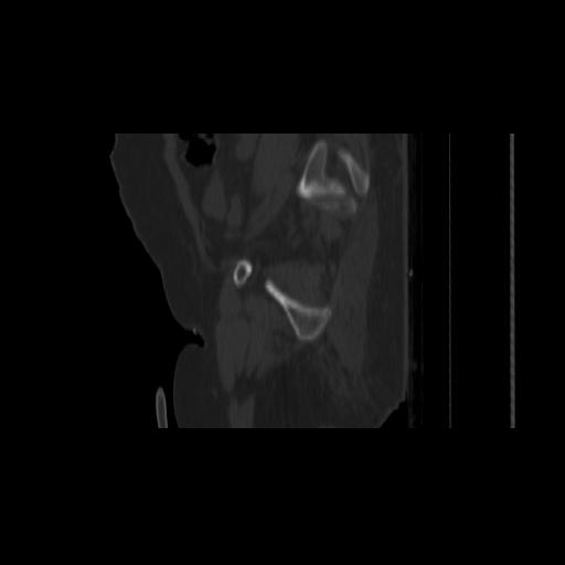 Carcinoma cervix- brachytherapy applicator (Radiopaedia 33135-34173 Sagittal bone window 145).jpg
