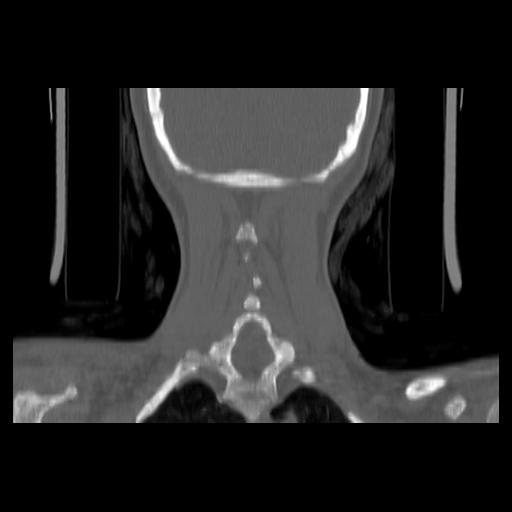 Carcinoma of the maxillary antrum (Radiopaedia 53805-59888 Coronal bone window 128).jpg