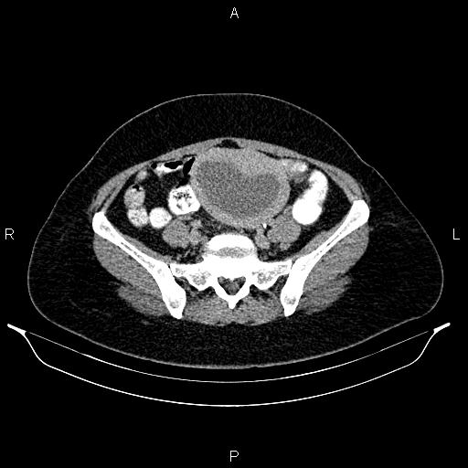 File:Carcinoma of uterine cervix (Radiopaedia 85861-101700 Axial C+ delayed 62).jpg