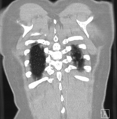 Cardiac sarcoidosis (Radiopaedia 74548-85534 Coronal lung window 64).jpg