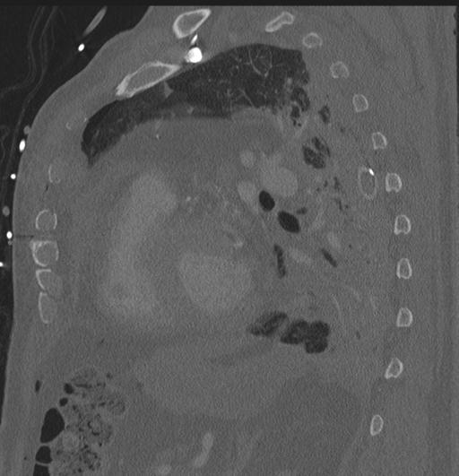 Cardiac trauma (Radiopaedia 32874-33858 Sagittal bone window 8).jpg
