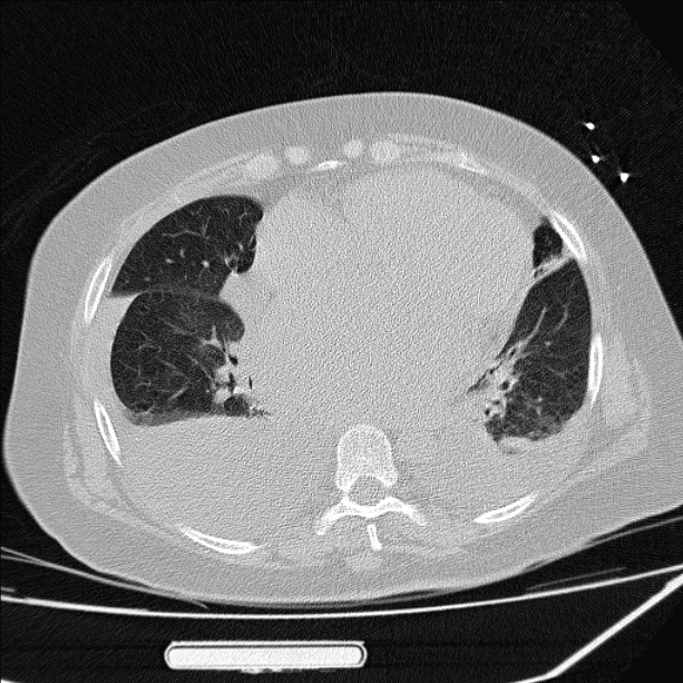 Cardiogenic pulmonary edema (Radiopaedia 29213-29609 Axial lung window 63).jpg