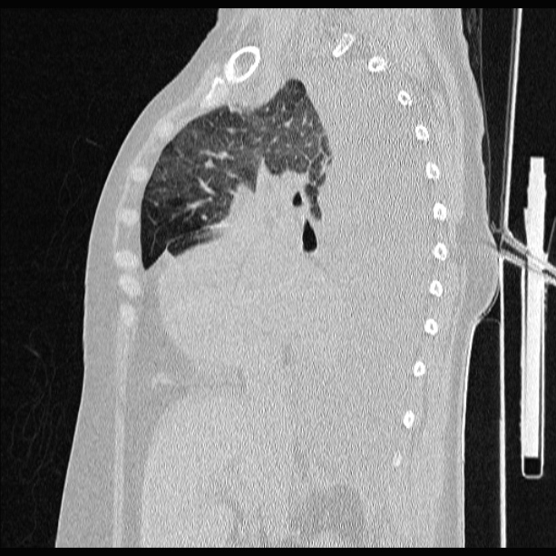 Cardiogenic pulmonary edema (Radiopaedia 29213-29609 Sagittal lung window 39).jpg