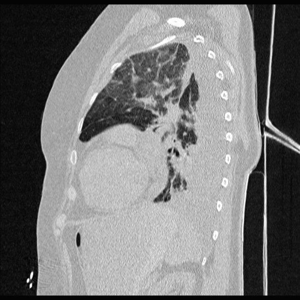 Cardiogenic pulmonary edema (Radiopaedia 29213-29609 Sagittal lung window 70).jpg