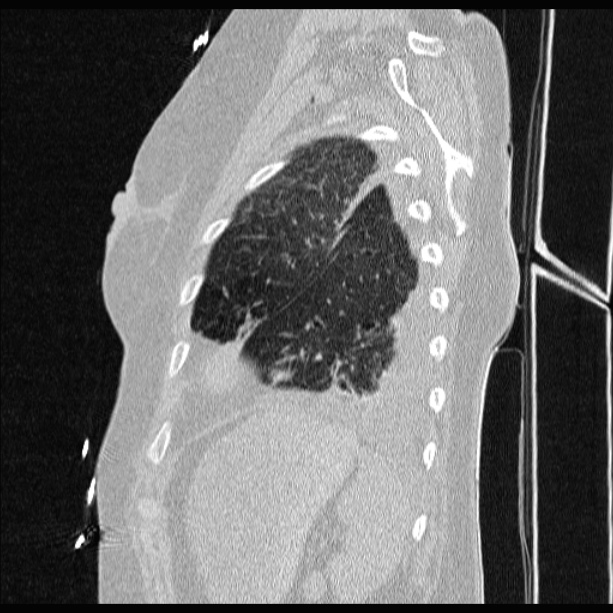 Cardiogenic pulmonary edema (Radiopaedia 29213-29609 Sagittal lung window 80).jpg