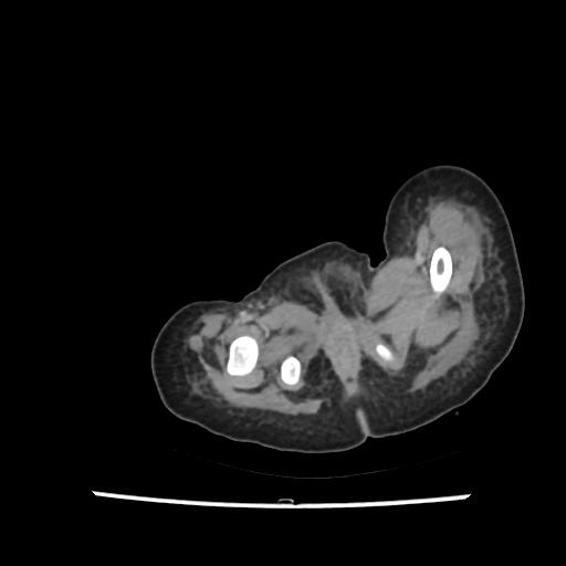 File:Caroli disease with autosomal recessive polycystic kidney disease (ARPKD) (Radiopaedia 89651-106703 B 243).jpg