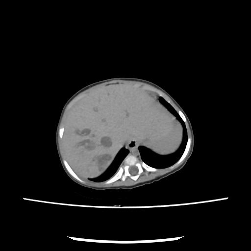 Caroli disease with autosomal recessive polycystic kidney disease (ARPKD) (Radiopaedia 89651-106703 E 30).jpg