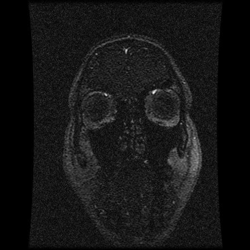 Carotid arterial dissection with acute cerebral infarction (Radiopaedia 26636-26784 MRV 137).jpg