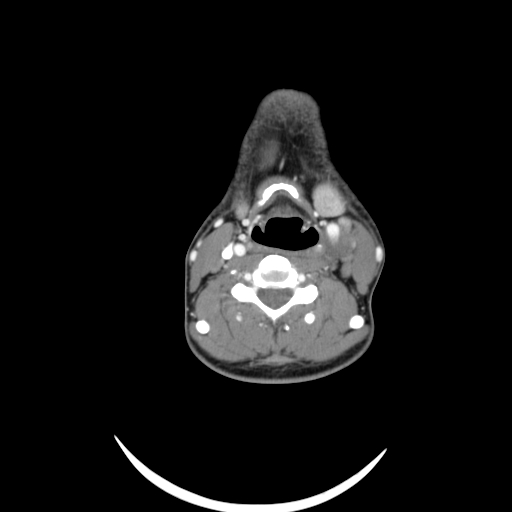 Carotid bulb pseudoaneurysm (Radiopaedia 57670-64616 A 39).jpg
