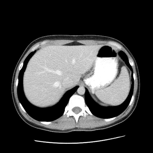 Castleman disease with fibrous pseudotumor in the abdomen (Radiopaedia 77296-89373 A 22).jpg