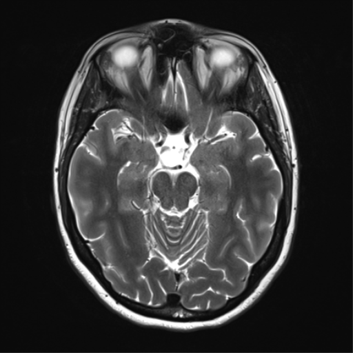 File:Cavernoma with bleed - midbrain (Radiopaedia 54546-60773 Axial T2 15).png