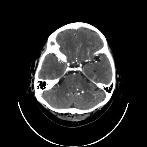 File:Cavernoma with developmental venous anomaly (Radiopaedia 22470-22506 C+ arterial phase 10).jpg