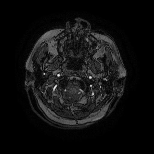 Cavernoma with developmental venous anomaly (Radiopaedia 22470-22507 MRA 106).jpg