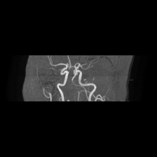 Cavernoma with developmental venous anomaly (Radiopaedia 22470-22507 MRA 6).jpg