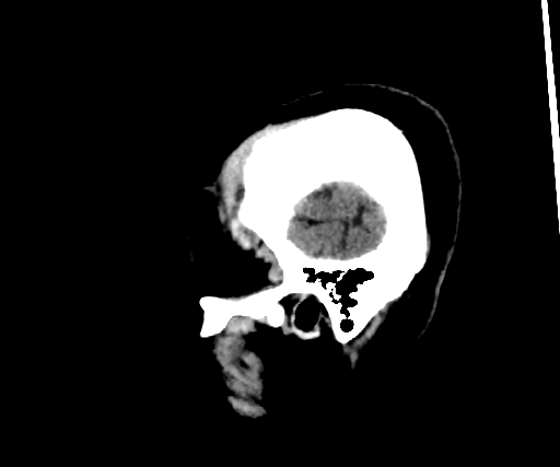 Cavernous hemangioma of the cerebellar falx (Radiopaedia 73025-83723 B 32).jpg