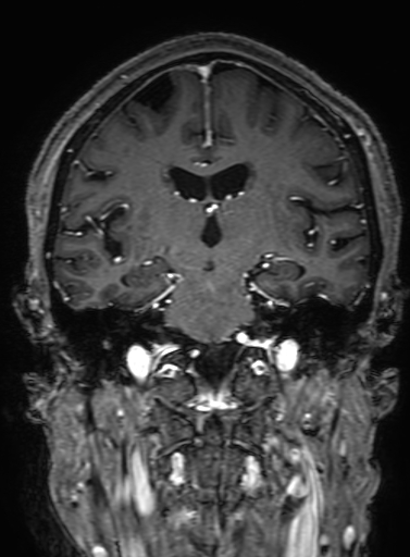 Cavernous hemangioma of the cerebellar falx (Radiopaedia 73025-83724 Coronal T1 C+ 202).jpg