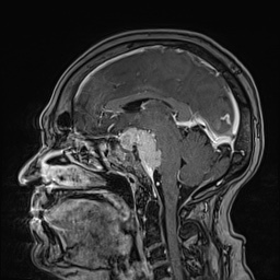 Cavernous sinus meningioma (Radiopaedia 63682-72367 Sagittal T1 C+ 91).jpg