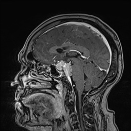 Cavernous sinus meningioma (Radiopaedia 63682-72367 Sagittal T1 C+ 95).jpg