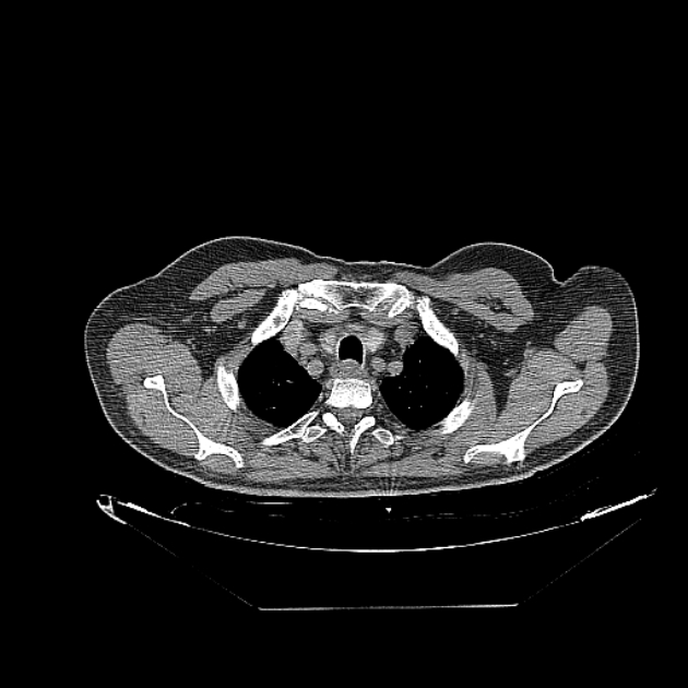 Cavitating bronchogenic carcinoma (Radiopaedia 44489-48162 Axial non-contrast 7).jpg