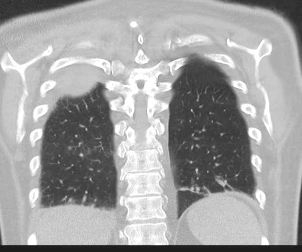 Cavitating pneumonia (Radiopaedia 45998-50329 Coronal lung window 39).png