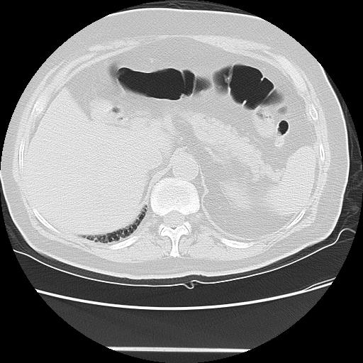 File:Cavitating pulmonary metastases (Radiopaedia 89545-106544 Axial lung window 56).jpg
