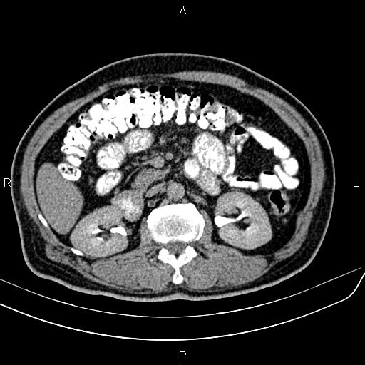 File:Cecal cancer with appendiceal mucocele (Radiopaedia 91080-108651 Axial C+ delayed 23).jpg