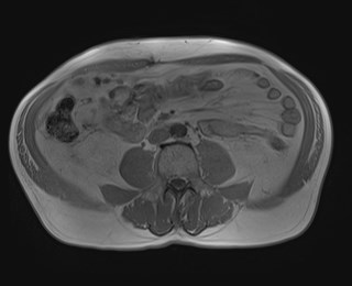 Cecal mass causing appendicitis (Radiopaedia 59207-66532 Axial T1 in-phase 80).jpg