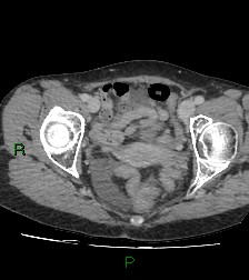 Cecal volvulus (Radiopaedia 86741-102900 A 121).jpg