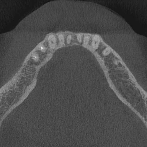 Cemento-osseous dysplasia (Radiopaedia 48251-53126 Axial non-contrast 29).jpg