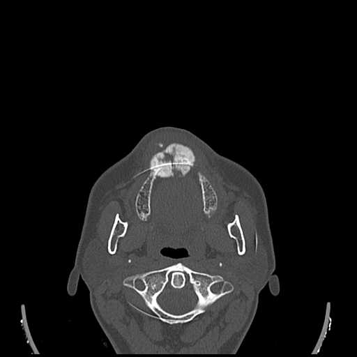 File:Cemento-ossifying fibroma (Radiopaedia 21243-21149 Axial bone window 8).jpg