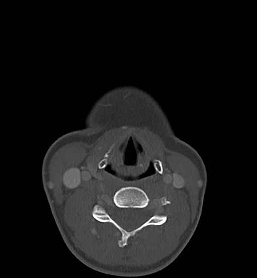 Cemento-ossifying fibroma (Radiopaedia 46243-50643 Axial bone window 54).png