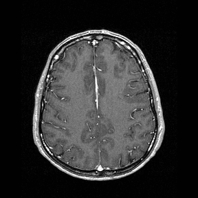 Central-variant posterior reversible encephalopathy syndrome (PRES) (Radiopaedia 43880-47358 Axial T1 C+ 118).jpg