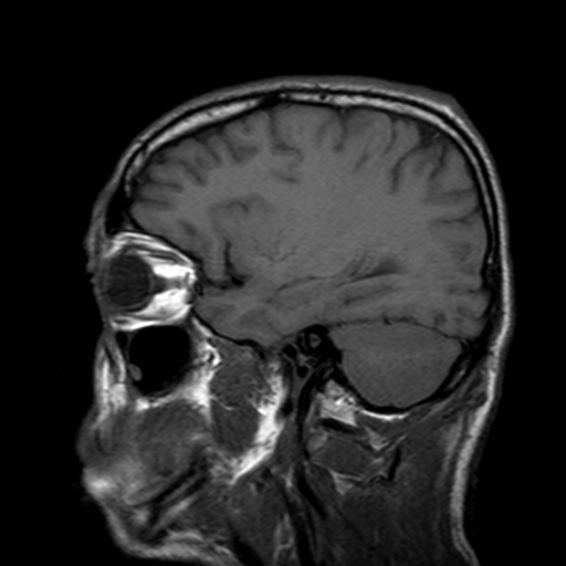 File:Central-variant posterior reversible encephalopathy syndrome (PRES) (Radiopaedia 43880-47358 Sagittal T1 6).jpg