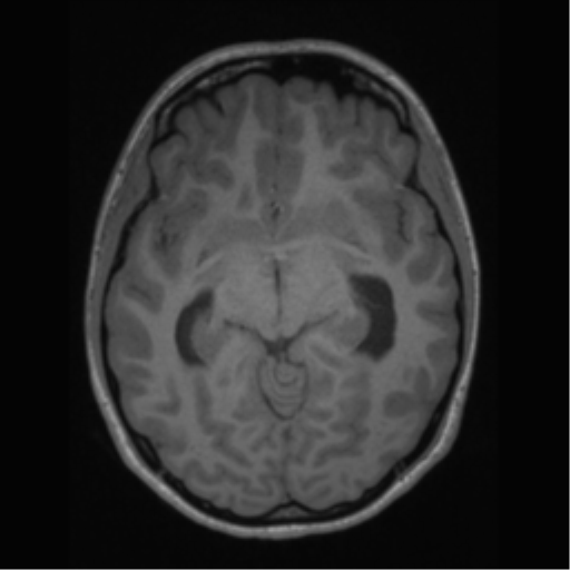 File:Central neurocytoma (Radiopaedia 37664-39557 Axial T1 31).png