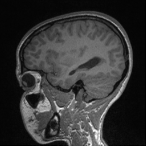 Central neurocytoma (Radiopaedia 37664-39557 Sagittal T1 70).png