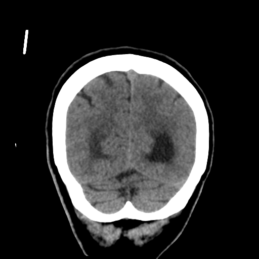 Central neurocytoma (Radiopaedia 65317-74346 Coronal non-contrast 50).png