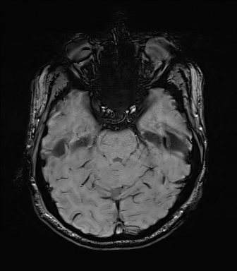 File:Central neurocytoma (Radiopaedia 71068-81303 Axial SWI 17).jpg