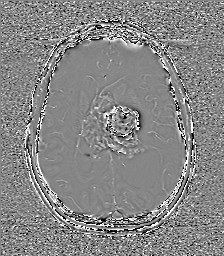 Central neurocytoma (Radiopaedia 84497-99872 Axial 42).jpg