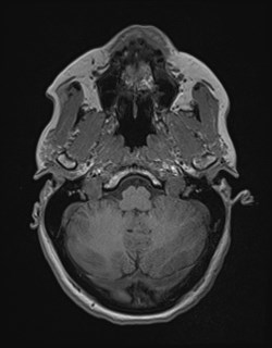 File:Central neurocytoma (Radiopaedia 84497-99872 Axial T1 45).jpg