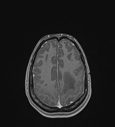 Central neurocytoma (Radiopaedia 84497-99872 Axial T1 C+ 122).jpg